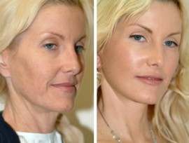 facelift