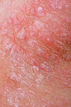 Steroid treatments are not what you want to be trying on a regular basis to treat psoriasis. If they're not working, why not try a home remedy?