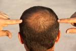 More men are turning to oral medications to treat baldness.
