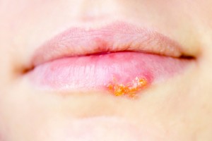 Cold sores can be caused by both herpes simplex types 1 and 2, the viruses that are also responsible for genital herpes.