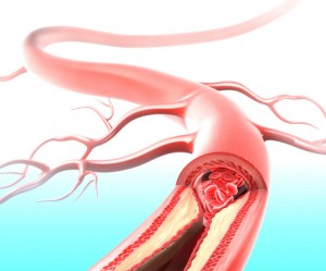 For many men, erection problems can be traced to atherosclerosis, a buildup of plaque on artery walls that can significantly diminish blood flow to the penis. 