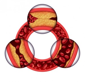 Men with early-stage vascular problems are more likely to develop erection problems than men with no signs of vascular disease, according to an American Heart Association study.