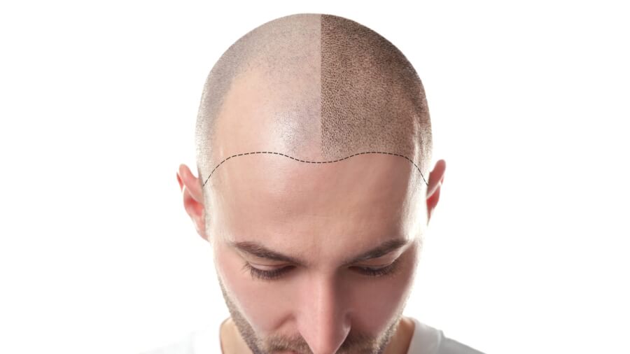Man with male pattern baldness.