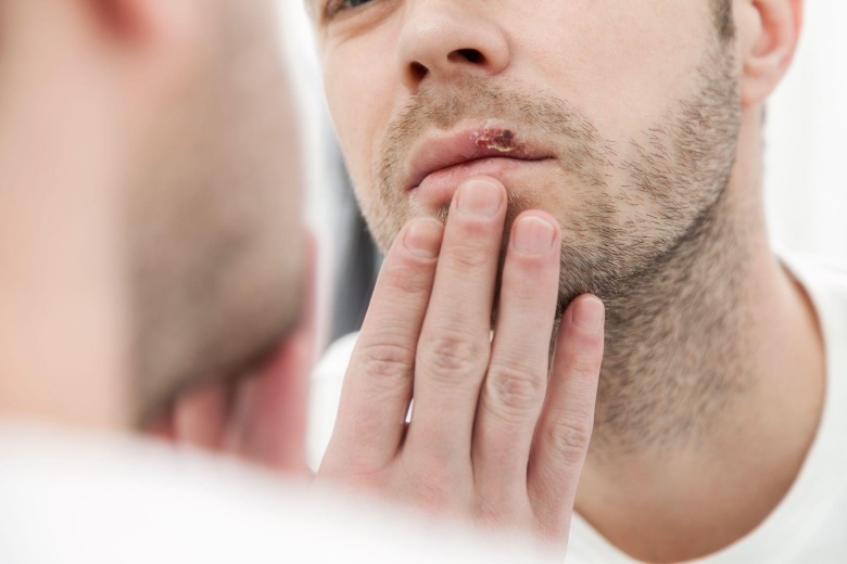 checking cold sore vs canker sore