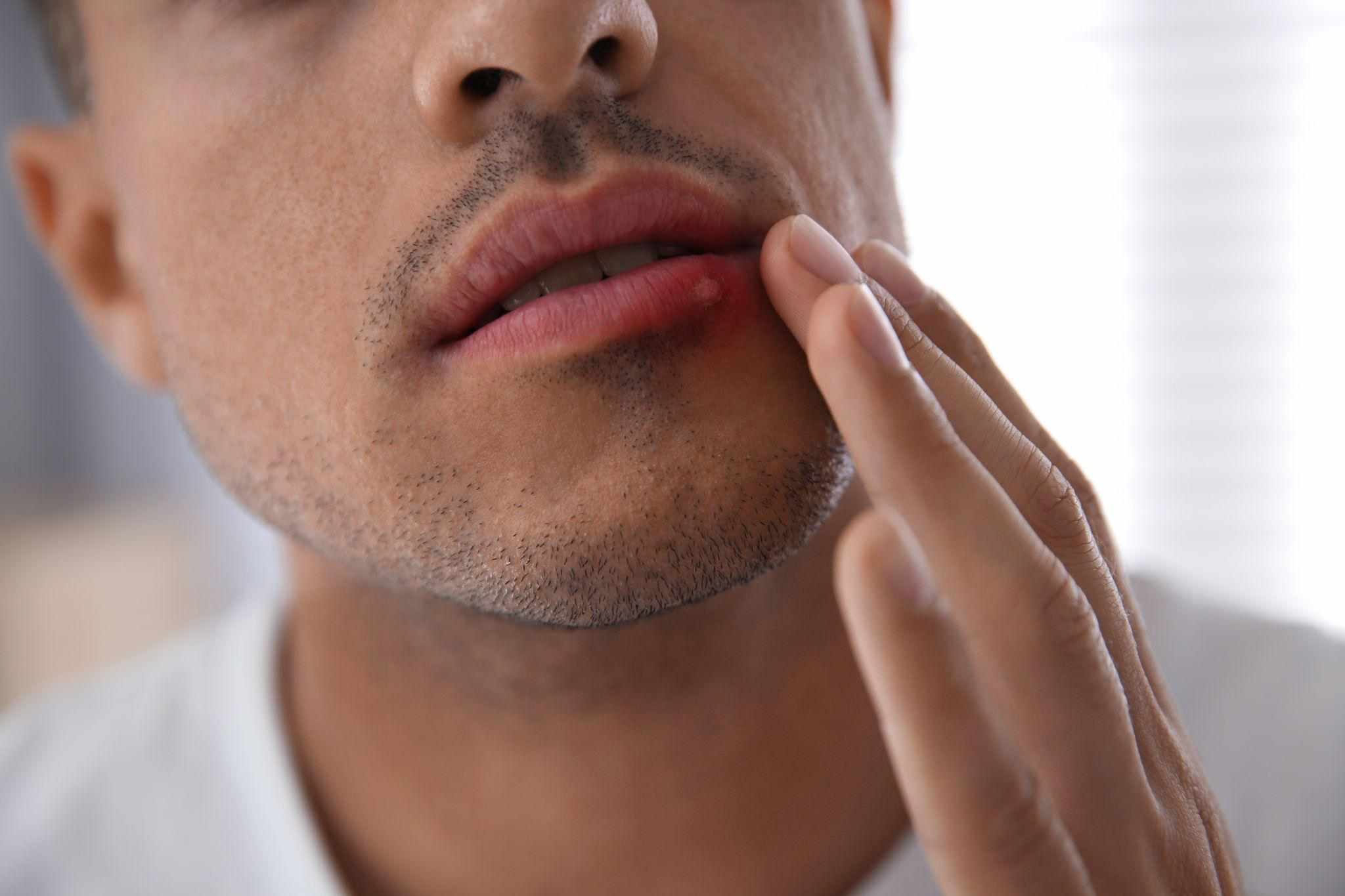 cold sore in men
