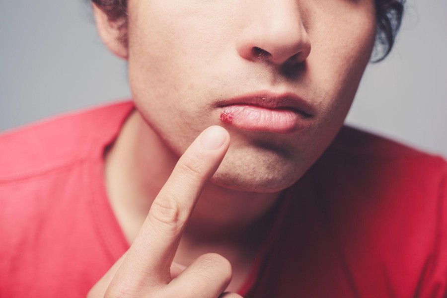 person pointing to a cold sore on lip
