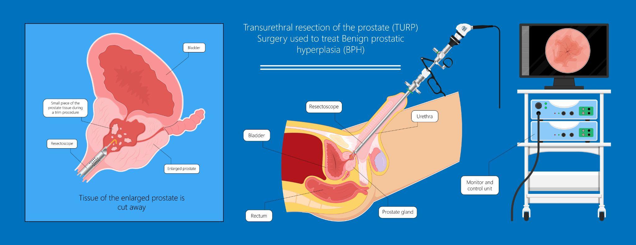 TURP surgery graphic TURP surgery graphic