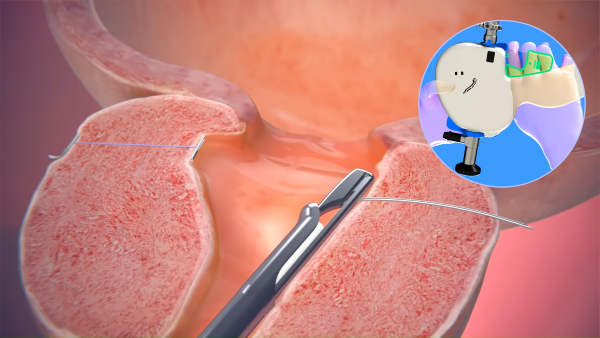 UroLift procedure UroLift procedure