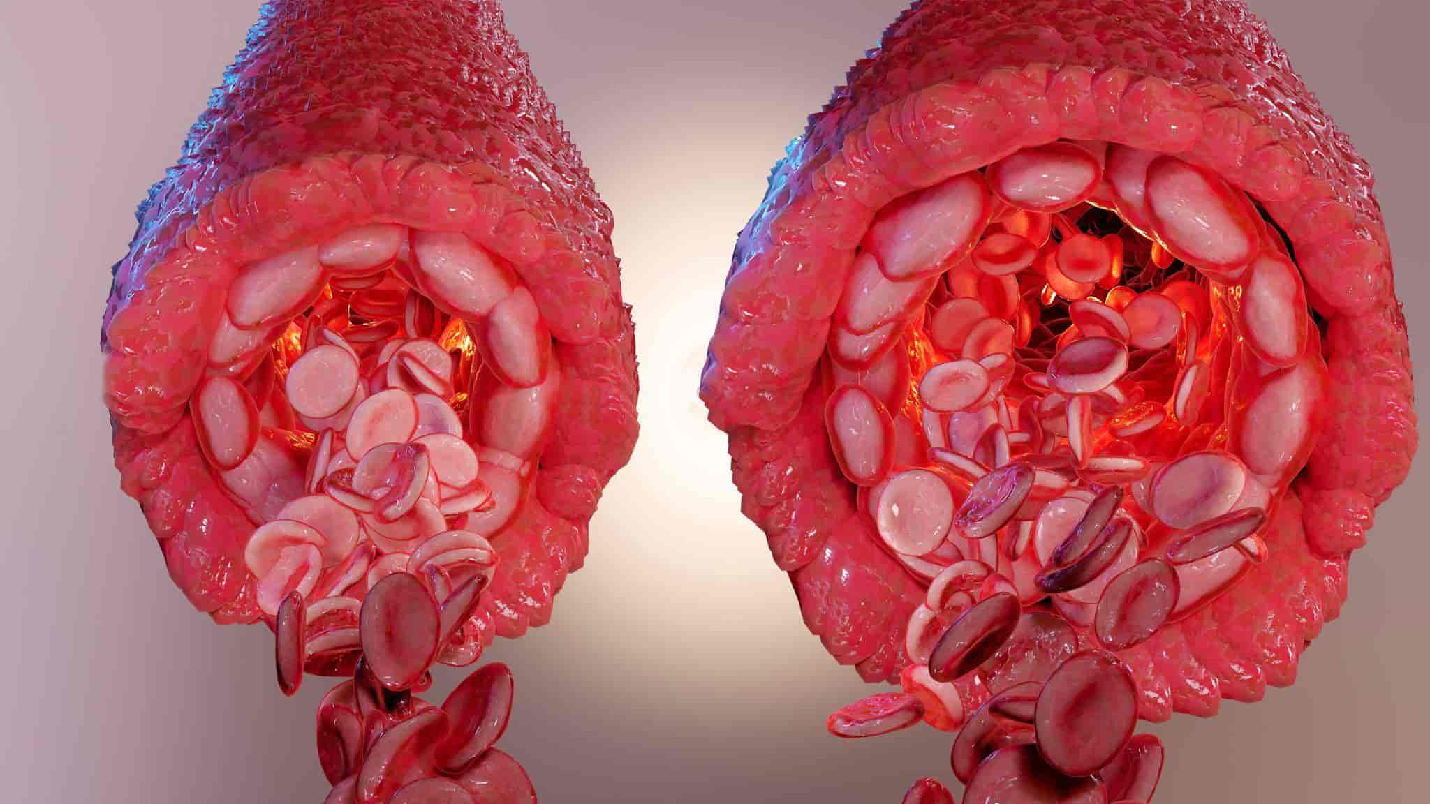 dilated blood vessels