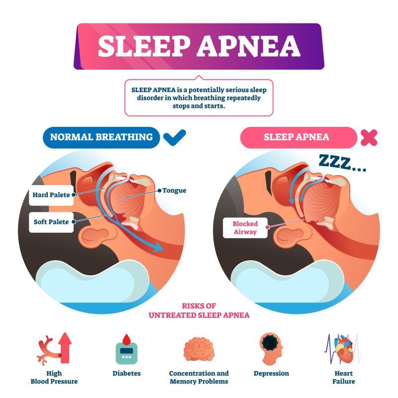 sleep apnea graphic representation