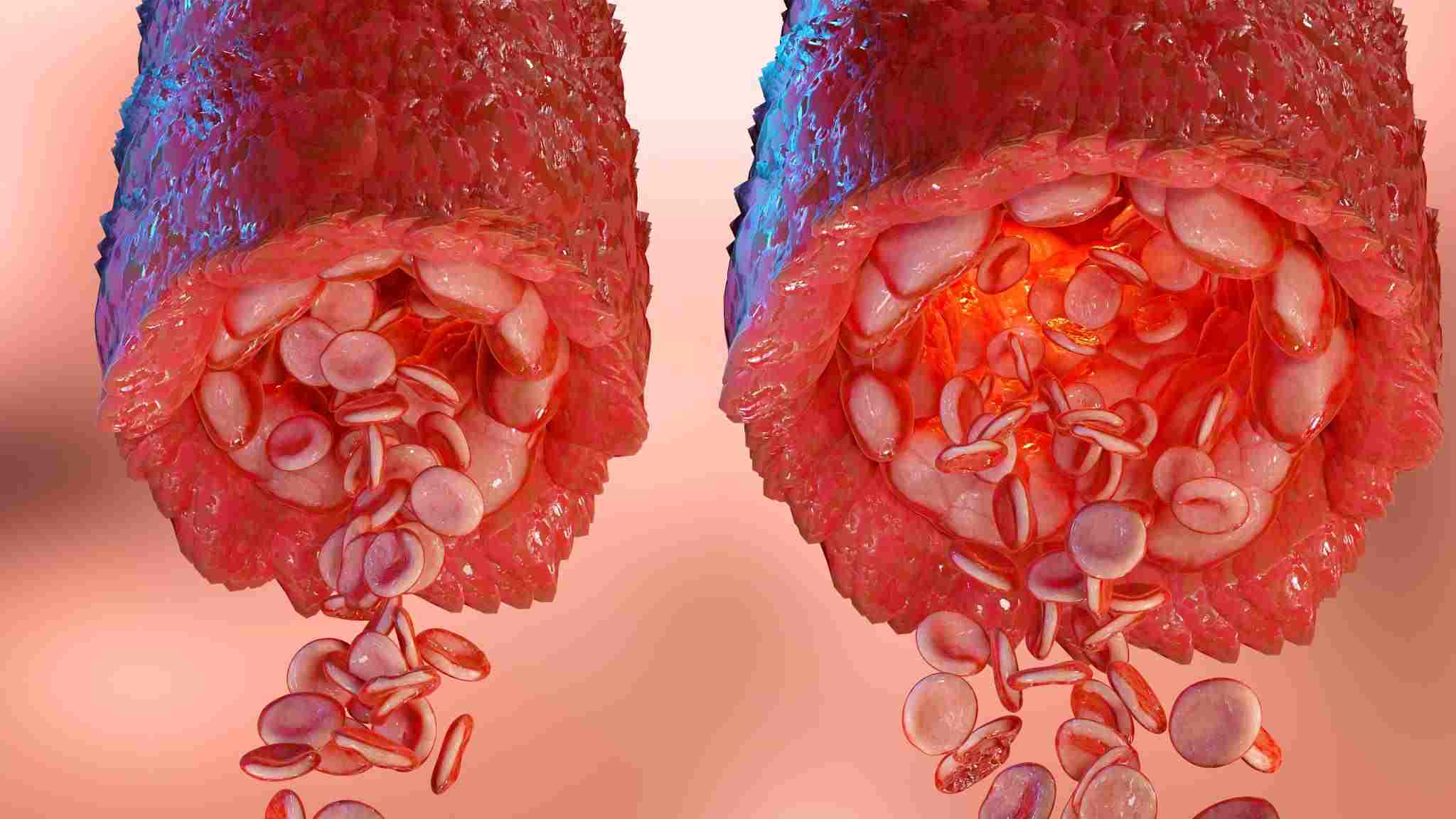 Dilated Blood Vessels Dilated Blood Vessels