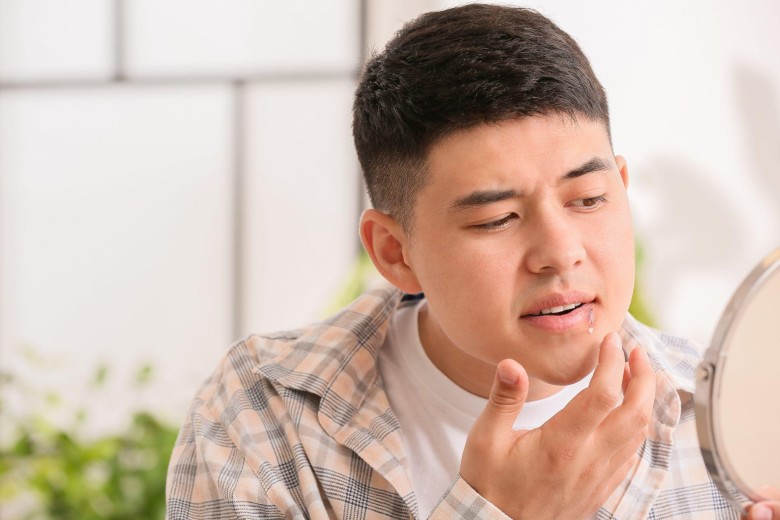 putting ointment on cold sores
