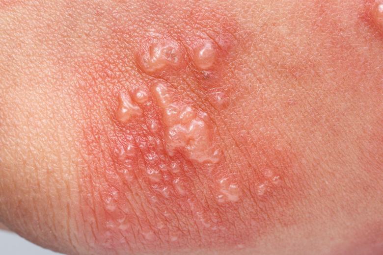 inflammation and blistering on skin