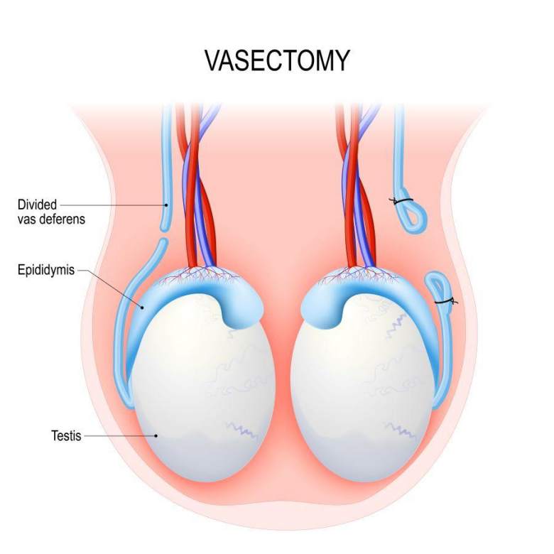 testicles and vas deferens involved in a vasectomy