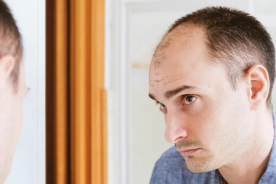Receding hairline treatment